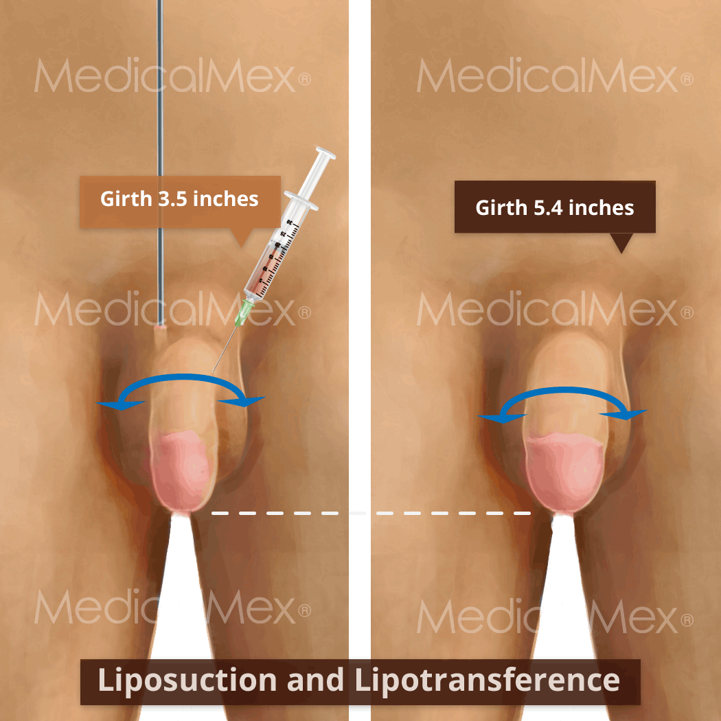 Enlargement of the penis with liposuction and transfer without lengthening  - MedicalMex