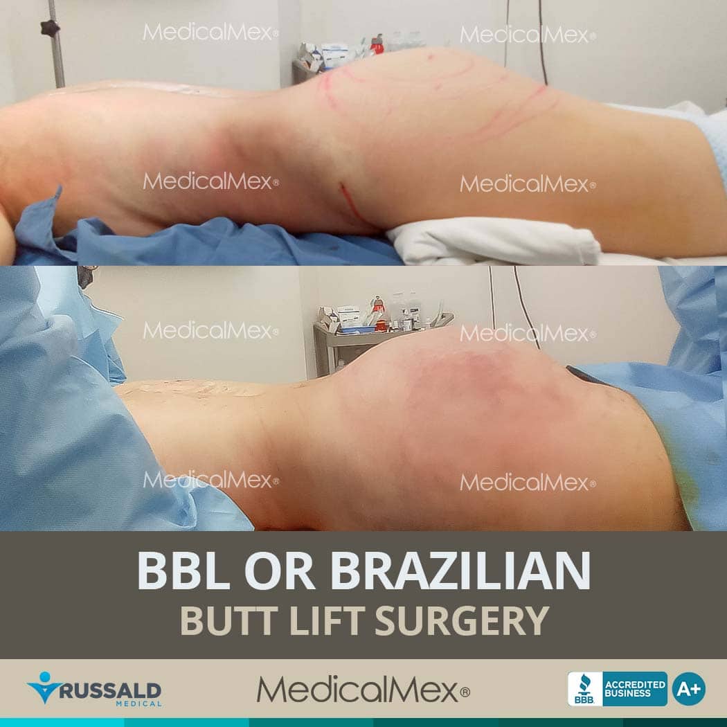 Brazilian Butt Lift Surgery in Tijuana, Mexico - MedicalMex
