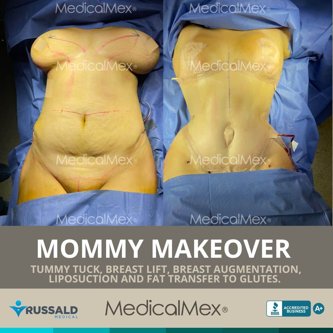 Tummy Tuck in Mexico - Mexico Cosmetic Center